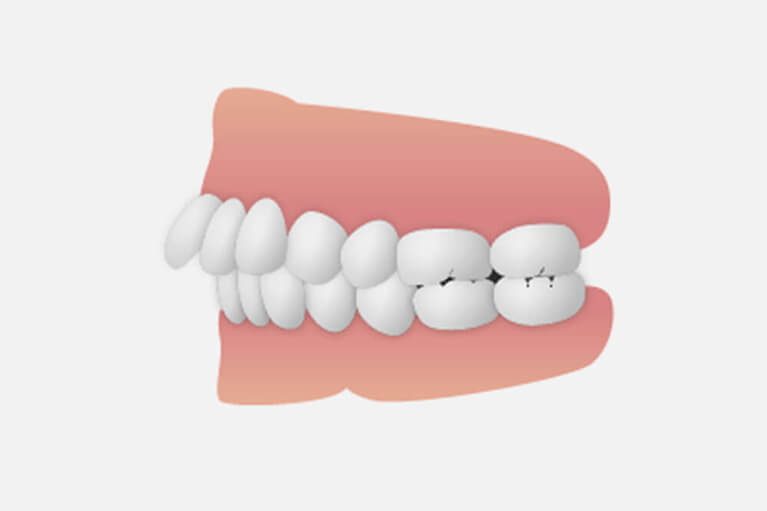 4．上の大人の前歯が出っ歯になっている