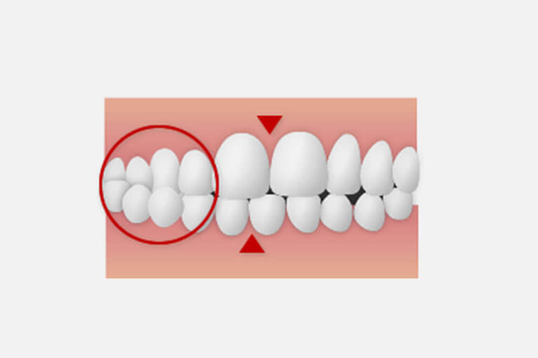 5．上下の前歯の真ん中の線がずれている